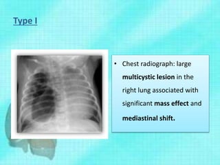 Type I
• Chest radiograph: large
multicystic lesion in the
right lung associated with
significant mass effect and
mediastinal shift.
 