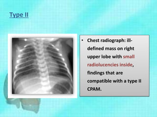 Type II
• Chest radiograph: ill-
defined mass on right
upper lobe with small
radiolucencies inside,
findings that are
compatible with a type II
CPAM.
 