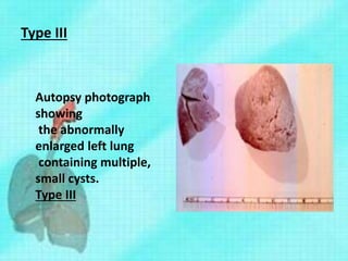 Type III
Autopsy photograph
showing
the abnormally
enlarged left lung
containing multiple,
small cysts.
Type III
 