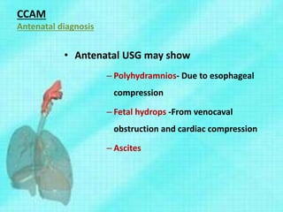 CCAM
Antenatal diagnosis
• Antenatal USG may show
– Polyhydramnios- Due to esophageal
compression
– Fetal hydrops -From venocaval
obstruction and cardiac compression
– Ascites
 