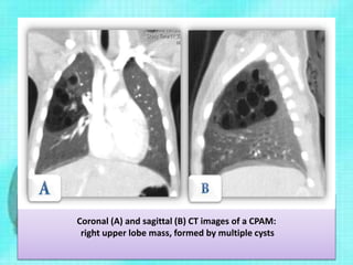 Coronal (A) and sagittal (B) CT images of a CPAM:
right upper lobe mass, formed by multiple cysts
 