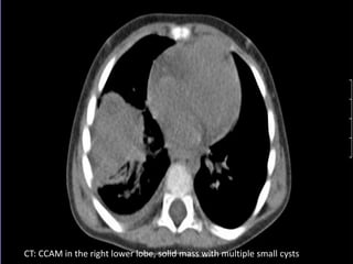 CT: CCAM in the right lower lobe, solid mass with multiple small cysts
 