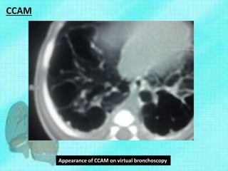 CCAM
Appearance of CCAM on virtual bronchoscopy
 