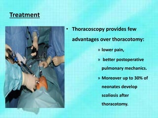 Treatment
• Thoracoscopy provides few
advantages over thoracotomy:
» lower pain,
» better postoperative
pulmonary mechanics.
» Moreover up to 30% of
neonates develop
scoliosis after
thoracotomy.
 