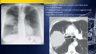 Lung Cancer
Lung cavity in edentulous patient more likely from
cancer than abscess
Thickest portion of cavity wall > 15 mm suggests tumor
Nodular cavity wall
Less likely to exhibit surrounding consolidation
 