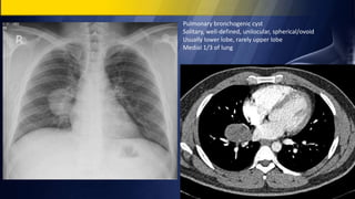 Pulmonary bronchogenic cyst
Solitary, well-defined, unilocular, spherical/ovoid
Usually lower lobe, rarely upper lobe
Medial 1/3 of lung
 