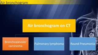 Air bronchogram
Air bronchogram on CT
Bronchoalevoler
carcinoma
Pulmonary lymphoma Round Pneumonia
 
