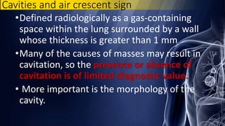 Cavities and air crescent sign
•Defined radiologically as a gas-containing
space within the lung surrounded by a wall
whose thickness is greater than 1 mm
•Many of the causes of masses may result in
cavitation, so the presence or absence of
cavitation is of limited diagnostic value.
• More important is the morphology of the
cavity.
 