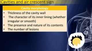 Cavity morphology
• Thickness of the cavity wall
• The character of its inner lining (whether
irregular or smooth)
• The presence and nature of its contents
• The number of lesions
Cavities and air crescent sign
 