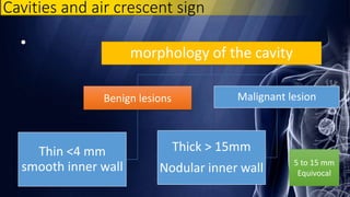 •
morphology of the cavity
Benign lesions
Thin <4 mm
smooth inner wall
Malignant lesion
Thick > 15mm
Nodular inner wall 5 to 15 mm
Equivocal
Cavities and air crescent sign
 