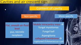 • Content of cavity
Non specific
Flat, smooth air-fluid
level
pus, necrotic
neoplasm
More specific
Mobile intracavitry mass 
fungal mycetomas
Fungal ball
Aspergiloma
collapsed membranes
ruptured Echinococcus cyst
Cavities and air crescent sign
 