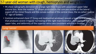 57-year-old woman with cough, hemoptysis and weight loss
• PA chest radiographs demonstrate a large right hilar mass with associated upper lobe
volume loss. Note the reverse “S” shape produced by the concave outline of the lateral
aspect of the minor fissure and the convex outline of the central mass, the so-called reverse
“S” sign of Golden.
• Contrast-enhanced chest CT (lung and mediastinal windows) reveals a large central mass
that produces severe irregular narrowing of the right main bronchus, atelectasis of the right
upper lobe, and deformity of the superior vena cava consistent with local invasion
Lung Cancer
 