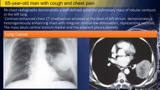 PA chest radiographs demonstrate a well defined spherical pulmonary mass of lobular contours
in the left lung
Contrast-enhanced chest CT (mediastinal window) at the level of left atrium demonstrates a
heterogeneously enhancing mass with irregular central low attenuation, representing necrosis.
The mass abuts central bronchi medial and the adjacent pleura laterally
65-year-old man with cough and chest pain
Lung Cancer
 