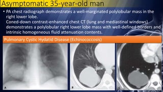 Asymptomatic 35-year-old man
• PA chest radiograph demonstrates a well-marginated polylobular mass in the
right lower lobe.
Coned-down contrast-enhanced chest CT (lung and mediastinal windows)
demonstrates a polylobular right lower lobe mass with well-defined borders and
intrinsic homogeneous fluid attenuation contents.
Pulmonary Cystic Hydatid Disease (Echinococcosis)
 