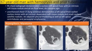 67-year-old man with hemoptysis and prior tuberculosis
• PA chest radiograph demonstrates a cavitary left apical mass with an intrinsic
soft tissue nodule and an air-fluid level. Air crescent sign
• unenhanced chest CT (lung window) demonstrates a left apical thick-walled
cavitary lesion with an intrinsic dependent soft-tissue nodule and small cavitary
satellite nodules. An adjacent pleural thickening as well as left apical
centrilobular and paraseptal emphysema.
Aspergillosis; Mycetoma
 