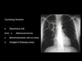 Cavitating Nodules
o Squamous cell
(mc) o Adenocarcinoma
o Bronchoalveolar cell ca (rare)
o Hodgkin's Disease (rare)
 