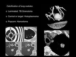 Calcification of lung nodules
o Laminated: TB Granuloma
o Central or target: Histoplasmoma
o Popcorn: Hamartoma
 