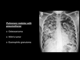 Pulmonary nodules with
pneumothorax
o Osteosarcoma
o Wilm's tumor
o Eosinophilic granuloma
 