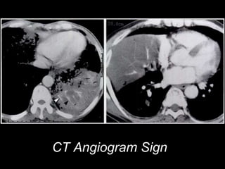CT Angiogram Sign
 