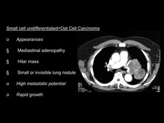 Small cell undifferentiated=Oat Cell Carcinoma
o Appearances
§ Mediastinal adenopathy
§ Hilar mass
§ Small or invisible lung nodule
o High metastatic potential
o Rapid growth
 