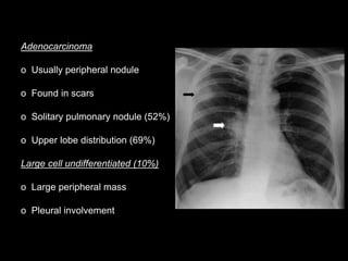 Adenocarcinoma
o Usually peripheral nodule
o Found in scars
o Solitary pulmonary nodule (52%)
o Upper lobe distribution (69%)
Large cell undifferentiated (10%)
o Large peripheral mass
o Pleural involvement
 