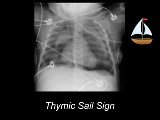 Thymic Sail Sign
 