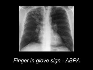 Finger in glove sign - ABPA
 