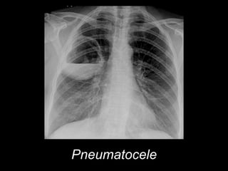 Pneumatocele
 