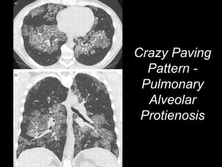 Crazy Paving
Pattern -
Pulmonary
Alveolar
Protienosis
 
