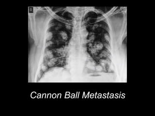Cannon Ball Metastasis
 
