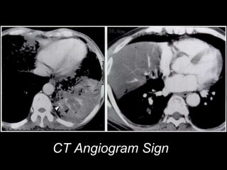 CT Angiogram Sign
 
