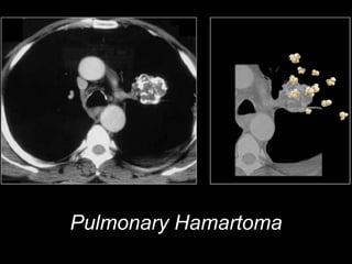 Pulmonary Hamartoma
 