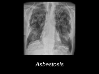 Asbestosis
 