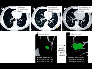 Doubling time
If a lesion doubles in volume
>6 weeks and <16 months,
usually malignant
 