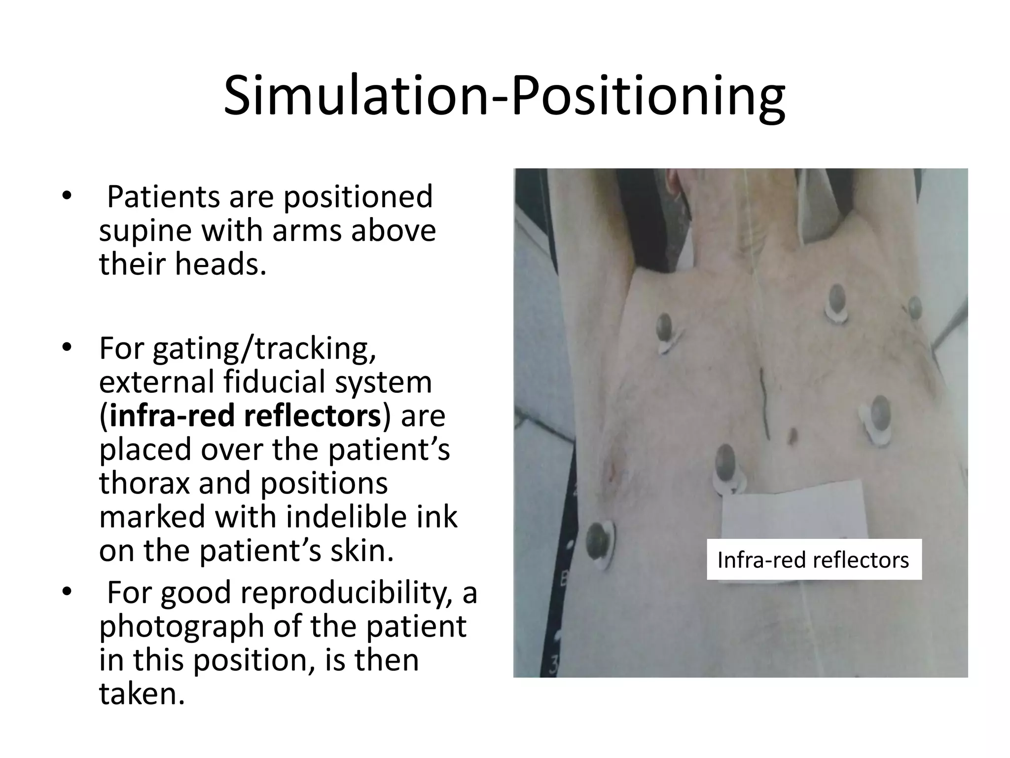 Simulation-Positioning
• Patients are positioned
supine with arms above
their heads.
• For gating/tracking,
external fiducial system
(infra-red reflectors) are
placed over the patient’s
thorax and positions
marked with indelible ink
on the patient’s skin.
• For good reproducibility, a
photograph of the patient
in this position, is then
taken.
Infra-red reflectors
 