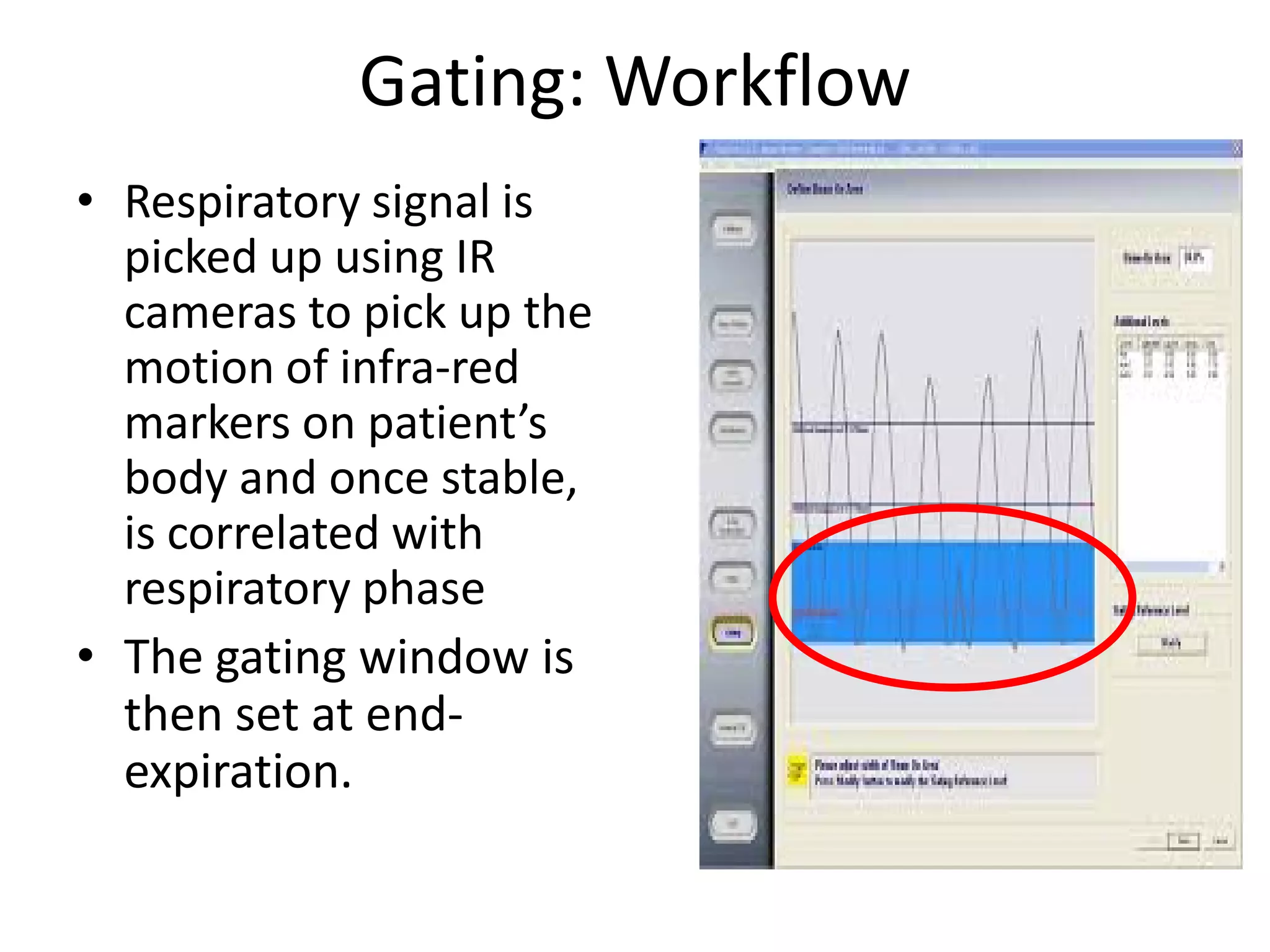 Gating: Workflow
• Respiratory signal is
picked up using IR
cameras to pick up the
motion of infra-red
markers on patient’s
body and once stable,
is correlated with
respiratory phase
• The gating window is
then set at end-
expiration.
 