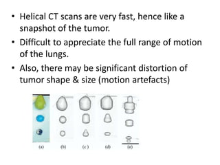 • Helical CT scans are very fast, hence like a
snapshot of the tumor.
• Difficult to appreciate the full range of motion
of the lungs.
• Also, there may be significant distortion of
tumor shape & size (motion artefacts)
 