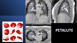 Lung imaging Using 3D Dual-Echo FID Ultra-short Echo Time MRI with novel Rosette k-space Pattern: PETALUTE