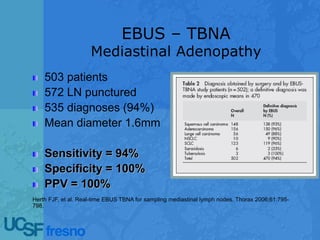 EBUS – TBNA
Mediastinal Adenopathy
503 patients
572 LN punctured
535 diagnoses (94%)
Mean diameter 1.6mm
Sensitivity = 94%
Specificity = 100%
PPV = 100%
Herth FJF, et al. Real-time EBUS TBNA for sampling mediastinal lymph nodes. Thorax 2006;61:795-
798.
 