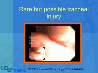 Rare but possible tracheal
injury
CETOC - Journal of Bronchology 2010;17:264-265.
 