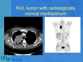 RUL tumor with radiologically
normal mediastinum
 