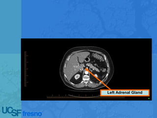 Left Adrenal Gland
 