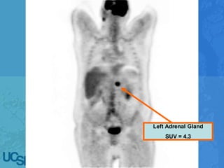 Left Adrenal Gland
SUV = 4.3
 