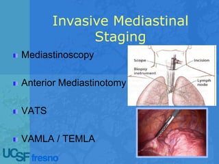 Invasive Mediastinal
Staging
Mediastinoscopy
Anterior Mediastinotomy
VATS
VAMLA / TEMLA
 