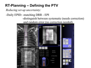 RT-Planning – Defining the PTV
Reducing set-up uncertainty:
-Daily EPID: -matching DRR - EPI
-distinguish between systematic (needs correction)
and random error (no correction needed)
 