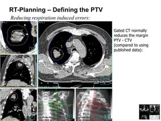 RT-Planning – Defining the PTV
Reducing respiration induced errors:
Gated CT normally
reduces the margin
PTV - CTV
(compared to using
published data):
 