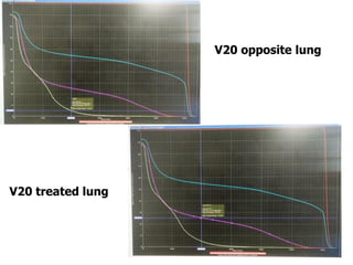 31
V20 opposite lung
V20 treated lung
 