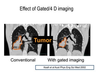 Conventional With gated imaging
Effect of Gated/4 D imaging
Tumor
Keall et al Aust Phys Eng Sci Med 2002
 
