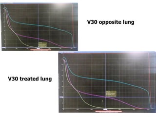 45
V30 opposite lung
V30 treated lung
 