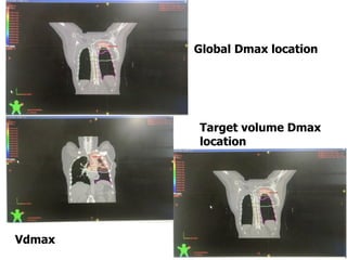 46
Global Dmax location
Target volume Dmax
location
Vdmax
 